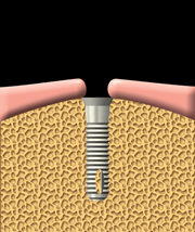 A dental implant is inserted into the jawbone